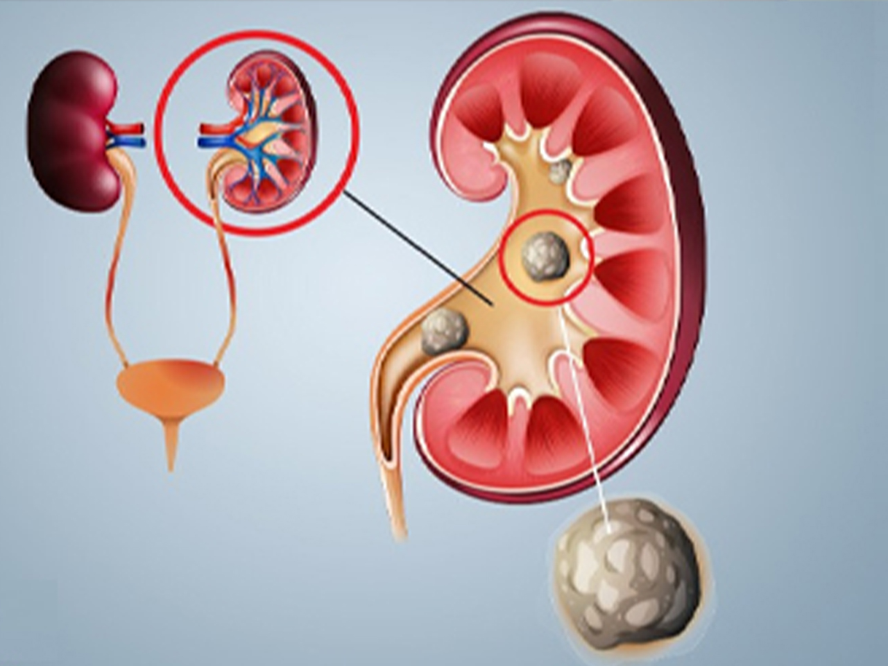 Kidney Stone Treatment